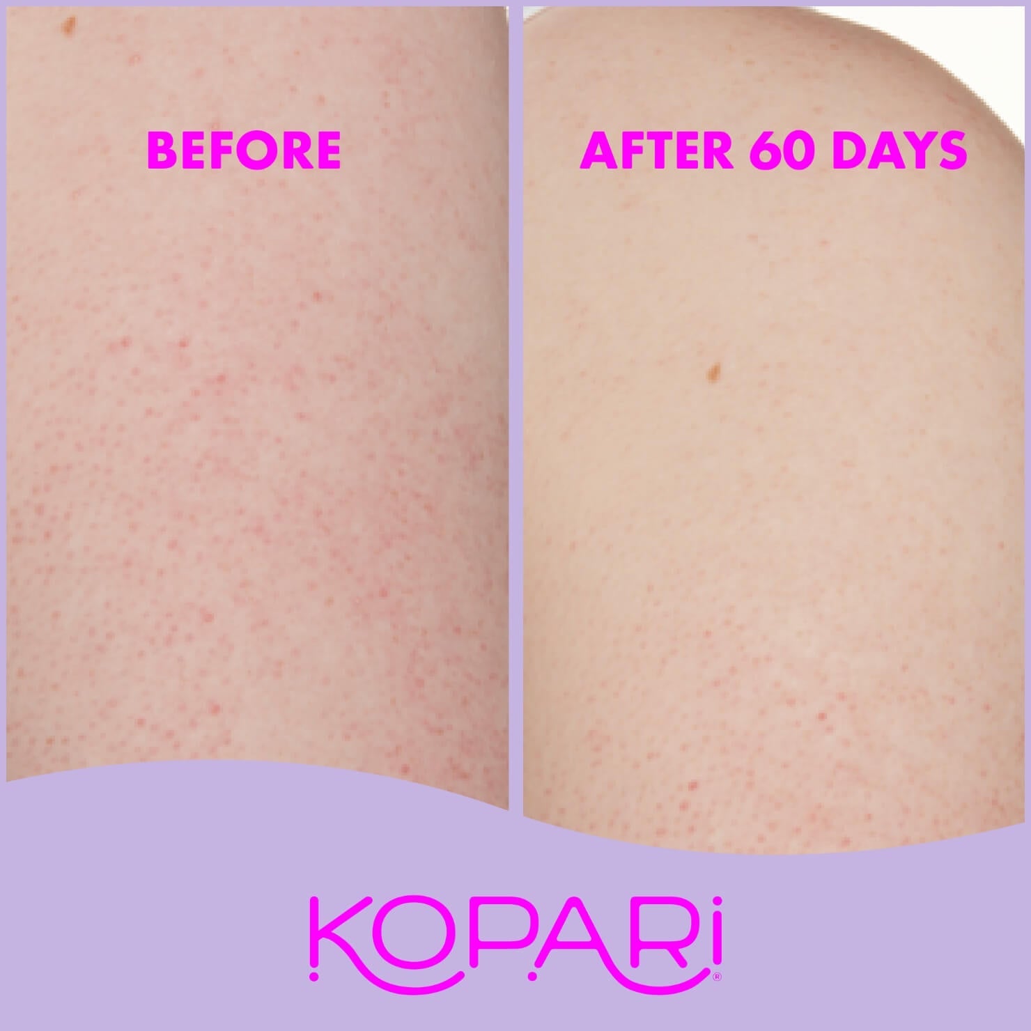 Mini KP Body Bumps Be Gone Scrub