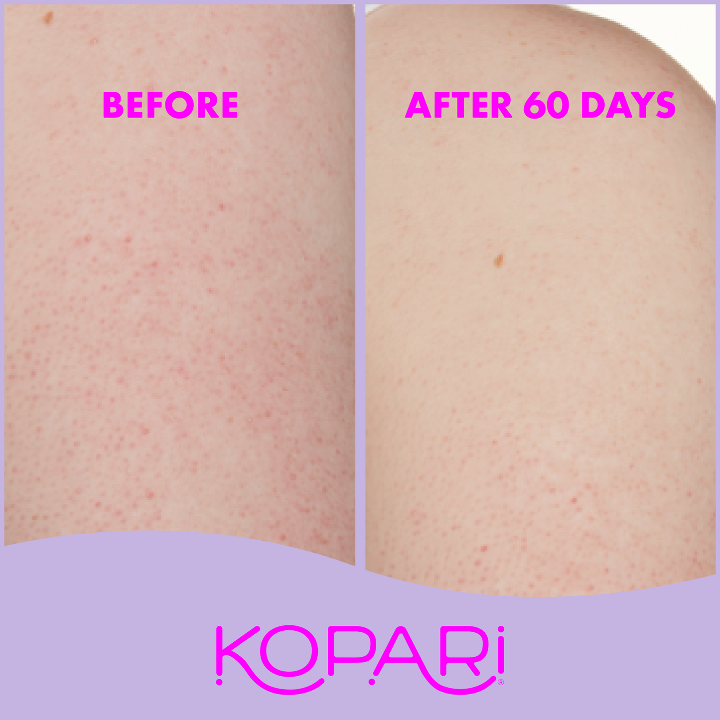 KP Body Bumps Be Gone Scrub